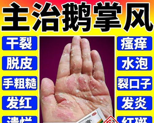 真菌感染的药物治疗方案（选择合适的药物治疗真菌感染）