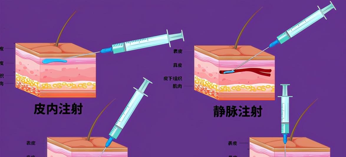 皮下注射（解析皮下注射的过程、用途与注意事项）