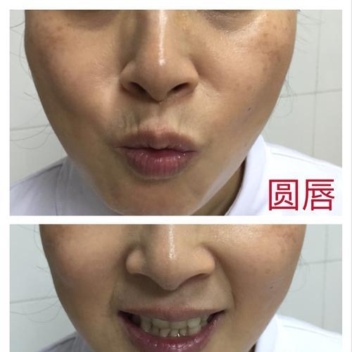 嘴唇圆圈为什么会疼？（探寻嘴唇圆圈疼痛背后的原因）