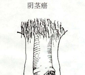 冠状病毒引发的疾病大揭秘（揭开冠状病毒引发的多种疾病面纱）